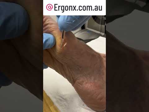 Satisfying Big Toe Callus Cutting: Experience the Oddly Gratifying Transformation!