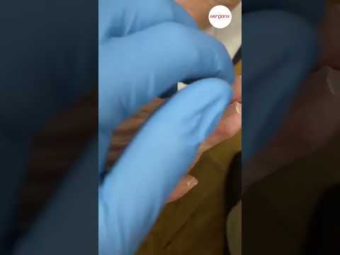 Say goodbye to painful corns! Watch as we transform your feet with expert debridement