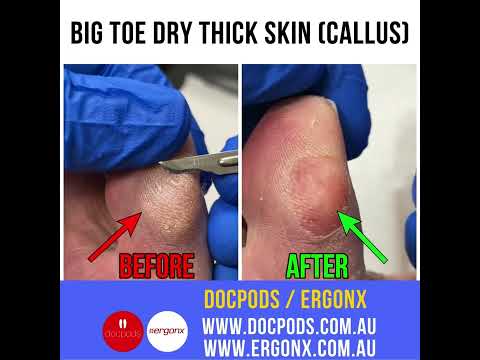 How to Manage Big Toe Calluses and Thick Dry Skin