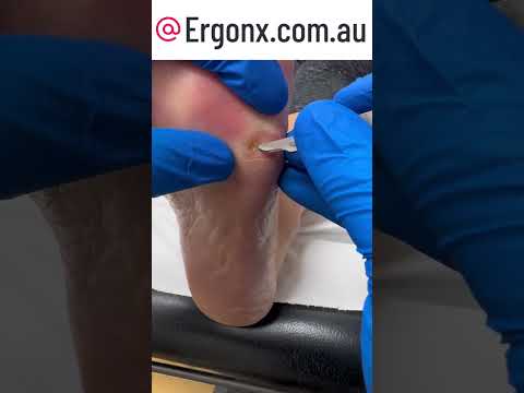 Ultimate Foot Care Transformation Satisfying Corn Removal ASMR by Expert Podiatrist
