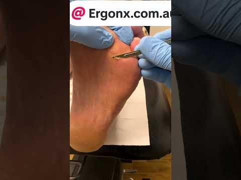 Professional Scalpel Removal for Forefoot Corns and Calluses