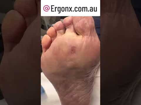 Say Goodbye to Painful Seed Corns Fast Easy Relief Tips for Happy Feet #FootCare #PainRelief