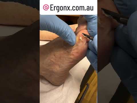 Satisfying Little Toe Callus Removal Transformation #CallusRemoval #SatisfyingTransformation