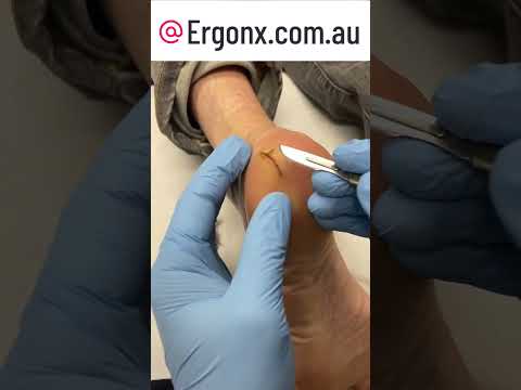 Say Goodbye to Cracked Heels: Expert Treatment & Removal at Podiatry Clinic #FootCare #CrackedHeels