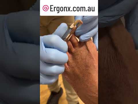 Satisfying Fungal Nail Cutting Transformation NailCare #OddlySatisfying #NailHealth