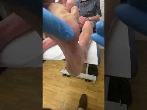 Say goodbye to painful foot corns! 🌟 Watch as I tackle stubborn calluses and restore soft, happy