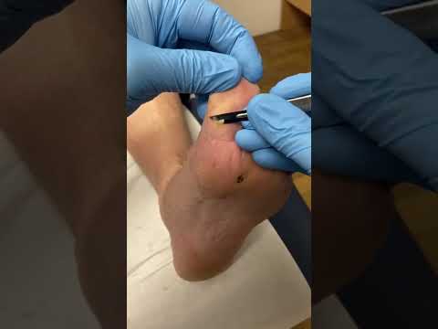Watch me tackle the ultimate peel satisfaction! 😲👣 Say goodbye to that stubborn callus on my big