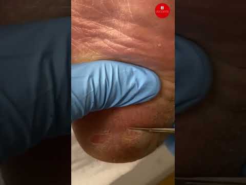 How Podiatrists Safely Debride Painful Heel Corns