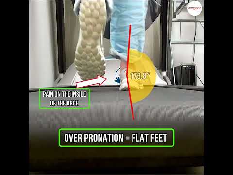 Discover how overpronation leads to flat feet and impacts your daily life! Say goodbye to foot pain