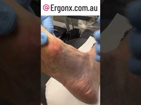 Extreme Callus Transformation: Watch Skilled Scalpel Debridement #Podiatry #CallusRemoval