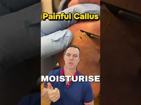 Ever had a painful hard lump under the ball of your foot? 👇 This is a plantar callus — and this one