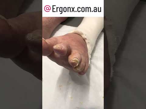 Satisfying Corn Removal from Toe - Watch a Podiatrist in Action! #FootCare #SatisfyingVideos