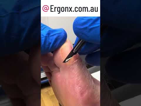 Ultimate Big Toe Callus Removal Transformation Podiatry Clinic #Podiatry #FootCare