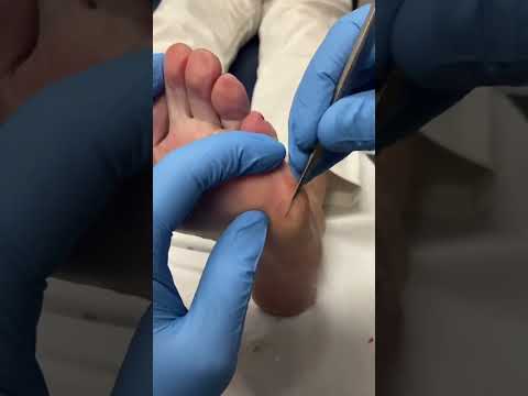 Say goodbye to painful corns with this satisfying removal! Watch the transformation and get ready to