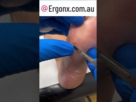 Fast & Painless Corn Removal by Expert Podiatrist #Podiatry #FootCare