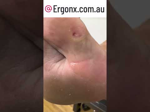 Big Toe Corn & Callus Removal by Podiatrist #Podiatry #FootCare
