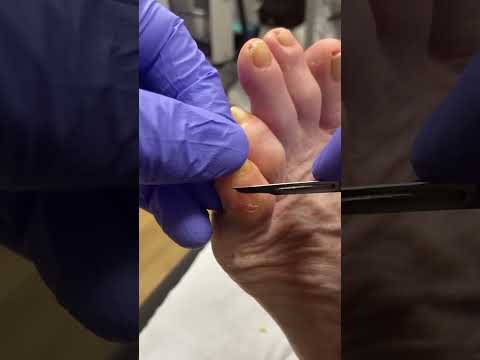 Say goodbye to that pesky corn on your little toe! Watch as this podiatrist works magic