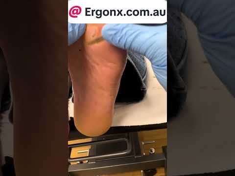 Forefoot Calluses: Pressure and Podiatry Care