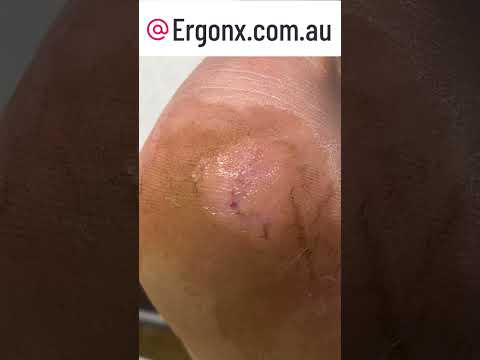 Ultimate Cracked Heel Callus Removal Satisfaction ASMR #SkincareRoutine #Satisfying