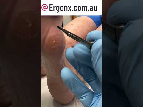 Oddly Satisfying Corn Cutting at Podiatry Clinic Pain Relief ASMR #Podiatry #CornCutting