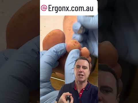 Amazing Callus Removal Transformation at Podiatry Clinic #FootCare #Podiatrist