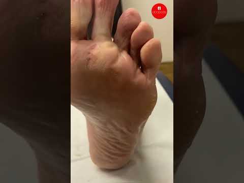 How Podiatrists Treat a Line of Corns on the Foot