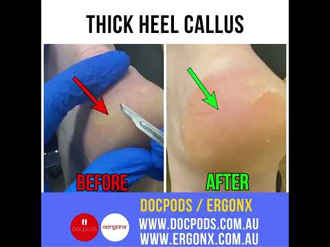 How Podiatrists Treat Thick Heel Calluses