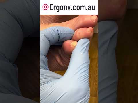 Ultimate Corn Removal! Watch a Podiatrist Transform Painful Toes #FootCare #PodiatryMagic