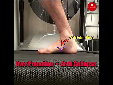 What Is Overpronation? Arch Collapse Explained