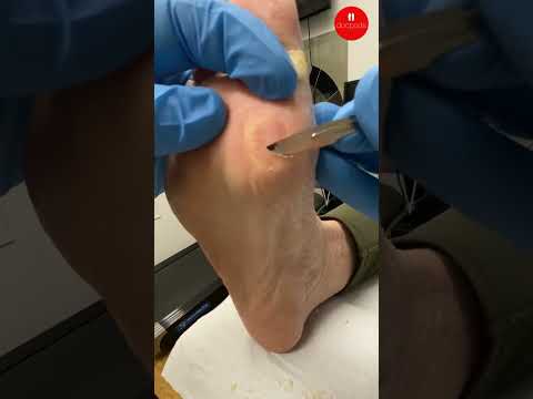 How Podiatrists Safely Debride Painful Foot Calluses
