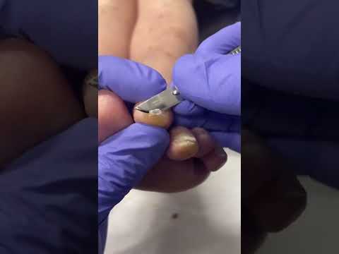 Watch this incredible toe transformation! 😲✨ Say goodbye to callus pain with expert podiatry care!