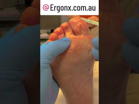 Mind-Blowing Seed Corn Removal by Podiatrist #FootCare #Podiatry