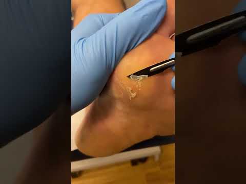 Transform your feet! 🦶✨ Watch a podiatrist skillfully debride warts before applying a precise acid