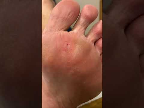 Say goodbye to that pesky corn! Watch this satisfying removal by a skilled podiatrist