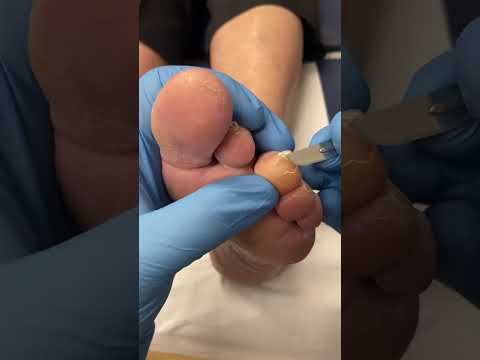 Watch this satisfying transformation as we tackle tough toe calluses and reveal soft, smooth skin!
