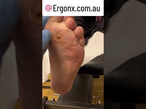 Say Goodbye to Painful Corns & Calluses Fast! #FootCareTips #HealthyFeet