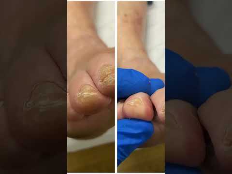 Oddly Satisfying: Watch Hard Skin Removal from Toes #Satisfying #Skincare