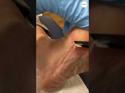 Bunion Callus Removal: How Podiatrists Debride Hard Skin