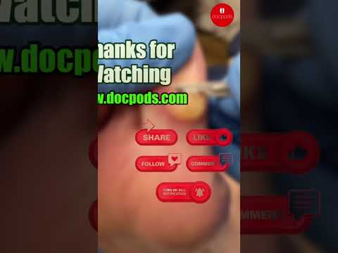 Big Toe Callus Removal: Podiatry Care and Tips