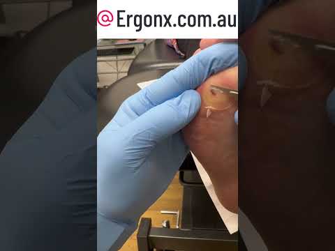 Satisfying Thick Callus Removal by Podiatrist Clinic #CallusCutting #FootCare