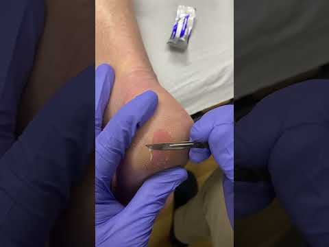 Say goodbye to painful cracked heels! Watch a skilled podiatrist work magic as they transform rough