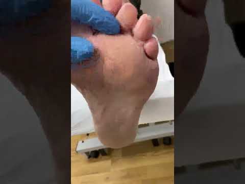 Discover the secret to smooth feet! 🦶✨ Watch a skilled podiatrist tackle a stubborn ball of foot