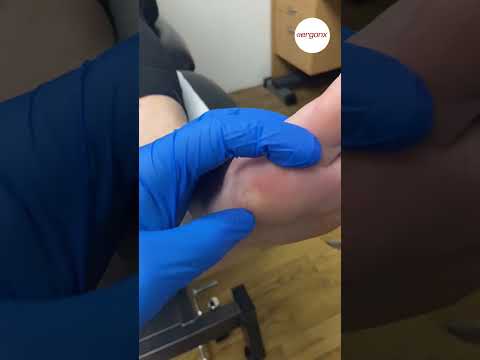 Ultimate Bunion Callus Removal: Pain Relief Tips for Steel Toe Boot Wearers #FootCare #BunionRelief