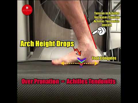 Discover the link between overpronation and Achilles tendonitis! 👣💥 Uncover tips to protect your