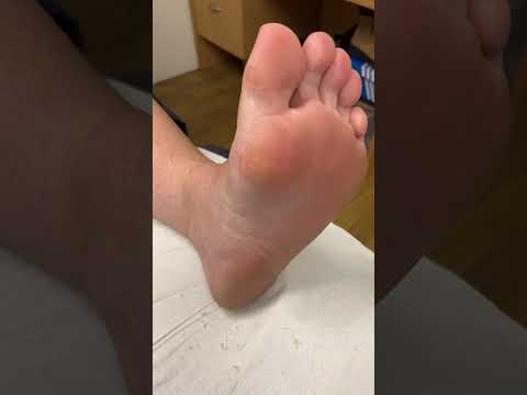 Transform your feet and feel the magic! Watch how to remove calluses from the medial foot