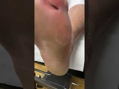 Watch this satisfying corn removal from the ball of the foot!👣 Say goodbye to discomfort and hello