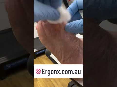 Satisfying Foot Callus Removal by Podiatrist #Podiatry #FootCare