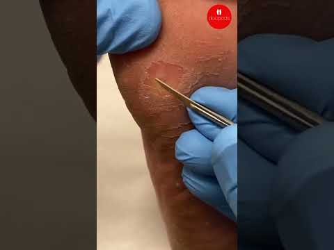 Hard Foot Corns: Pressure and Podiatry Care
