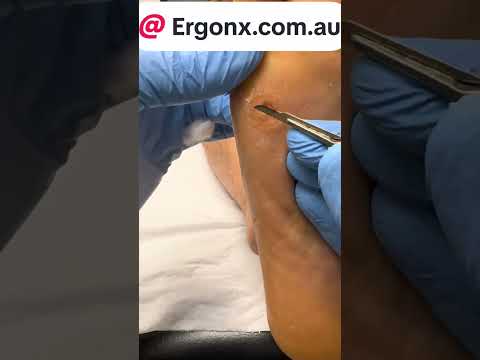 Watch This Giant Corn Removal from a Chef's Foot in Workboots #FootCare #ChefLife