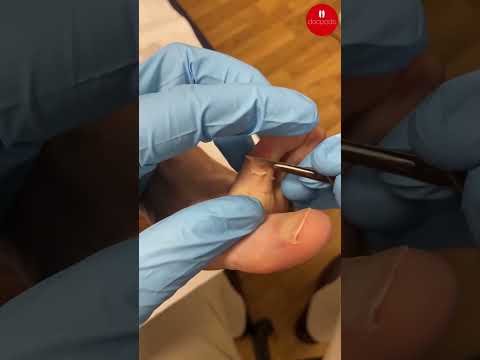 How Podiatrists Safely Remove a Corn Between Toes